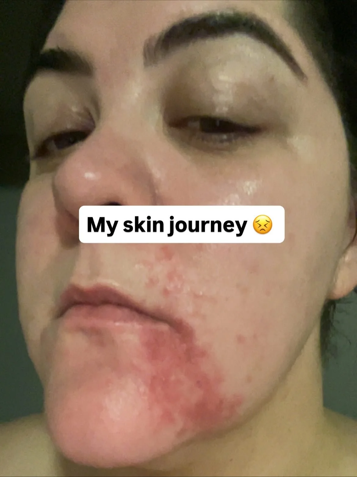 ✨ My skin journey ✨

For months I brushed this off&hellip; thinking it was &ldquo;just my skin acting up.&rdquo; I felt so self-conscious, but also hesitant to bring it up with my doctor because I didn&rsquo;t want to seem trivial or dramatic.😅 

It