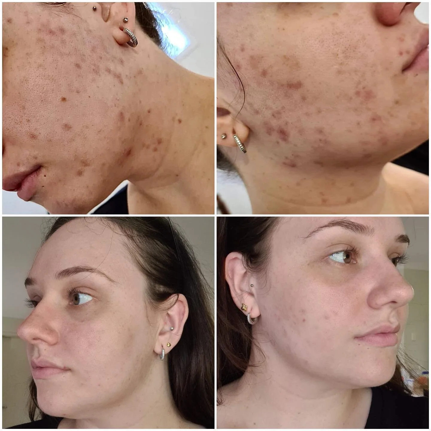 What a spectacular transformation 🥰😍👏Our very own therapist Emily&rsquo;s skin transformation! with proper treatments and home care, these results truly speaks for themselves🧡🧡