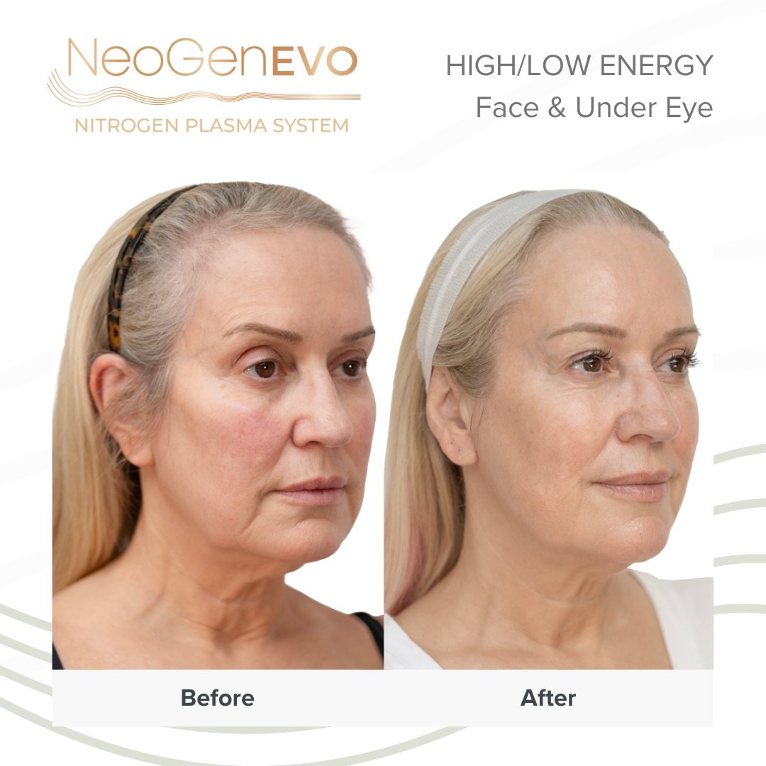 A new era of skin rejuvenation has arrived.

NeoGen Plasma uses nitrogen plasma technology to stimulate collagen, improve skin laxity, soften lines and rejuvenate ageing skin, including the delicate eye area.

Results shown here after treatment: smoo