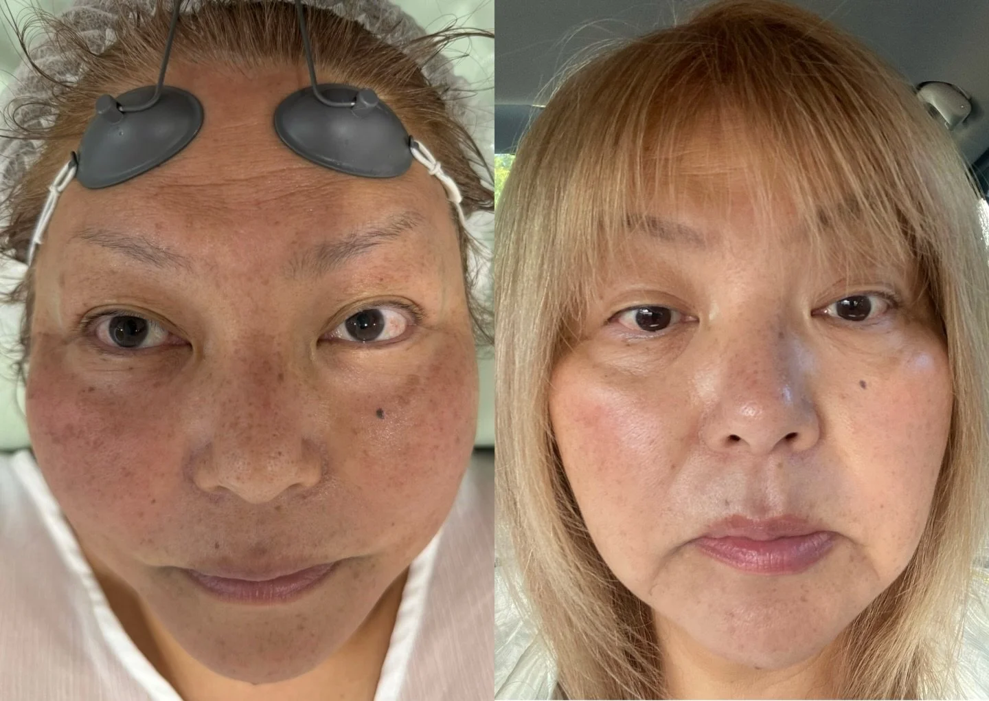 If your skin hasn&rsquo;t changed, what you&rsquo;re doing isn&rsquo;t working.
People waste years mucking around with skincare and treatments that barely scratch the surface.

If you actually want to reset your skin properly
BBL + Moxi is where you 