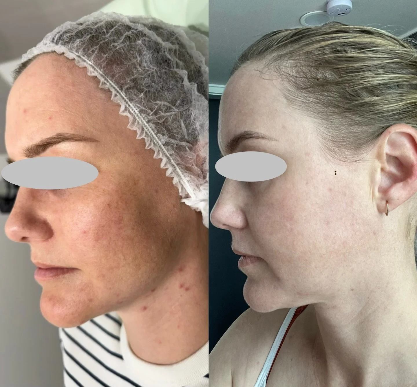 When skin is treated correctly, it responds.

Smoother. Clearer. More even.

This is what customised skin treatment looks like not guesswork, not generic.
 We will continue with correction and maintenance 💕