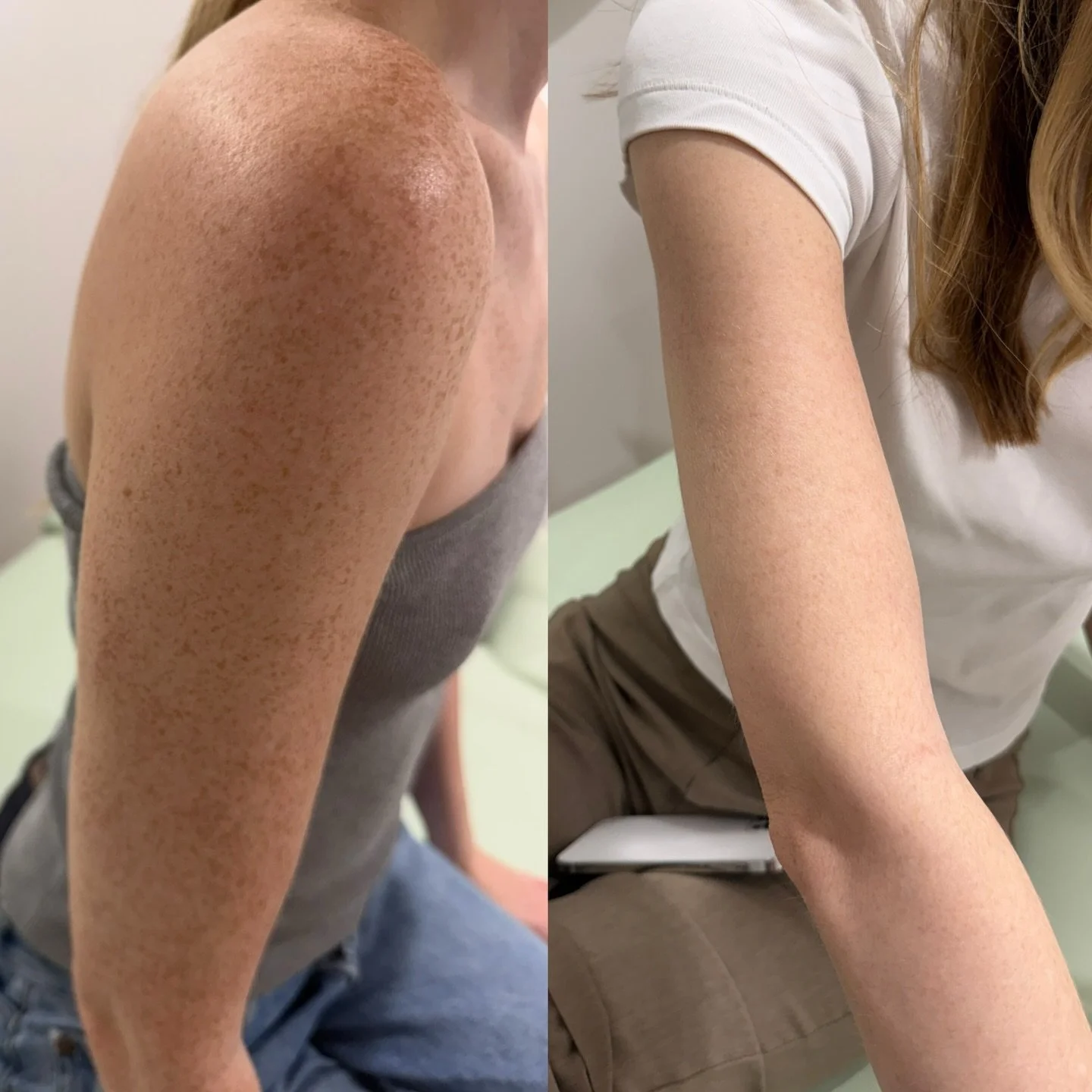 This is what targeted skin correction looks like when it&rsquo;s done properly.
No filters. No tricks. Just real results. 1 treatment 

✨ Brighter
✨ Clearer
✨ Even skin tone

Treatment: BBL HERO FOREVER BODY 

Limited appointments available.
Book via