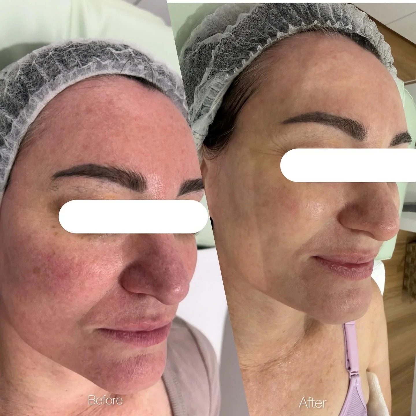 From dull, red, and textured skin to a golden, smooth, and even complexion ✨ This transformation is all about giving your skin the care and attention it deserves. Every step, every treatment, and every moment of patience has paid off resulting in rad