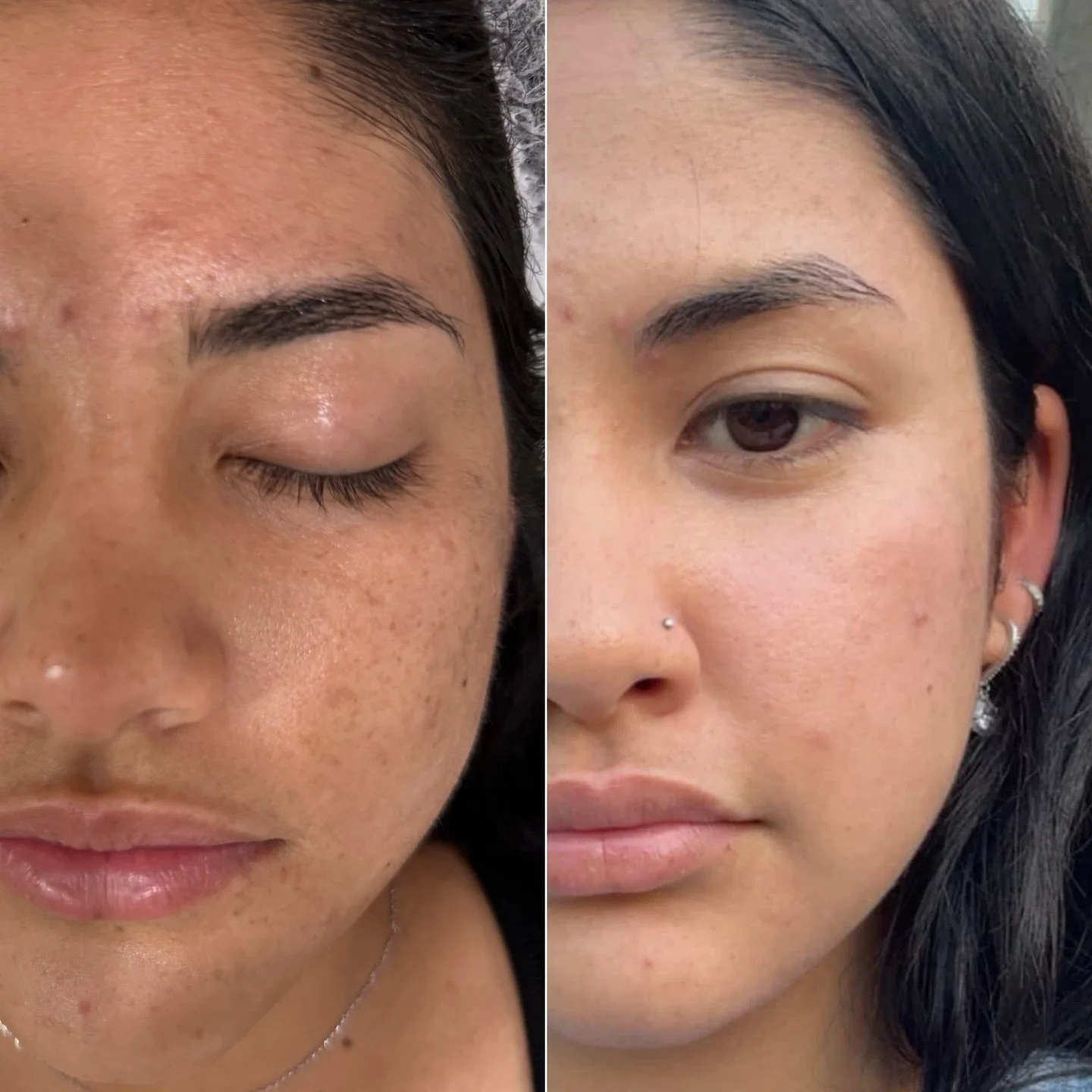 One week post MOXI ✨ and the glow is unreal 🥳
You honestly can&rsquo;t beat this laser for hormonal pigmentation the improvement in texture, brightness, and overall skin refinement speaks for itself. Smooth, radiant, and luminous skin in just 7 days