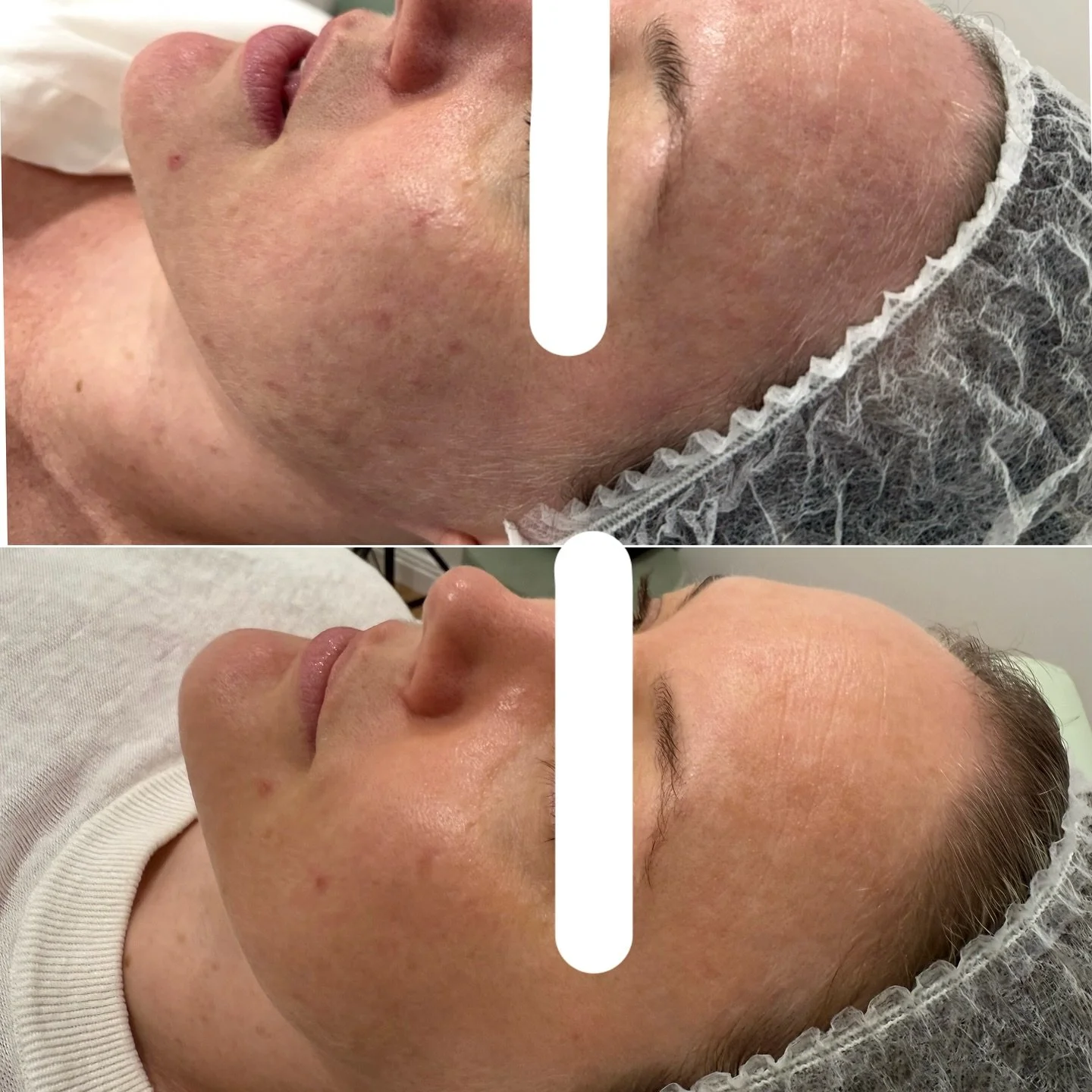 ✨ One Treatment, Remarkable Results! ✨

Our client experienced a stunning transformation with just 1 BBL Forever Young treatment addressing acne, redness, signs of aging, and restoring skin plumpness. This isn&rsquo;t just cosmetic; it&rsquo;s scient