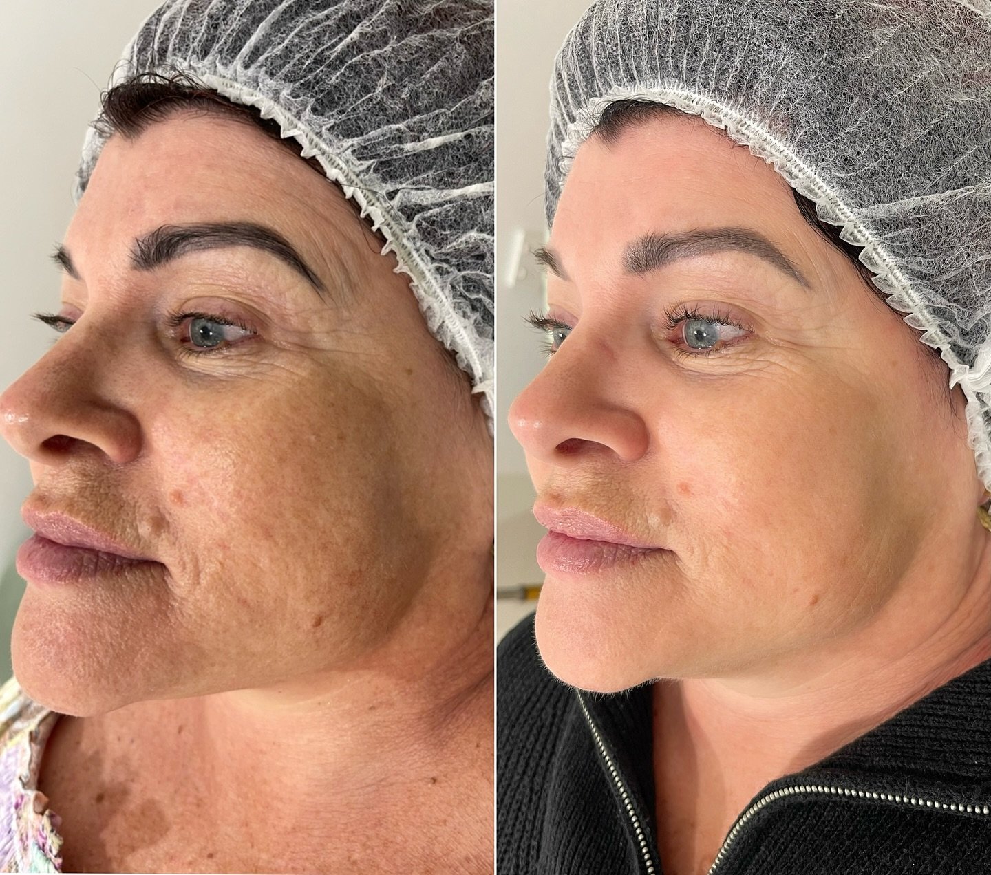 ✨ Skin that speaks volumes after just one Forever Young BBL. ✨
One session. Face &amp; neck. And the transformation? Breathtaking.
Her skin now glows with refined texture, luminous tone, and that unmistakable radiance that turns heads. No filters. No