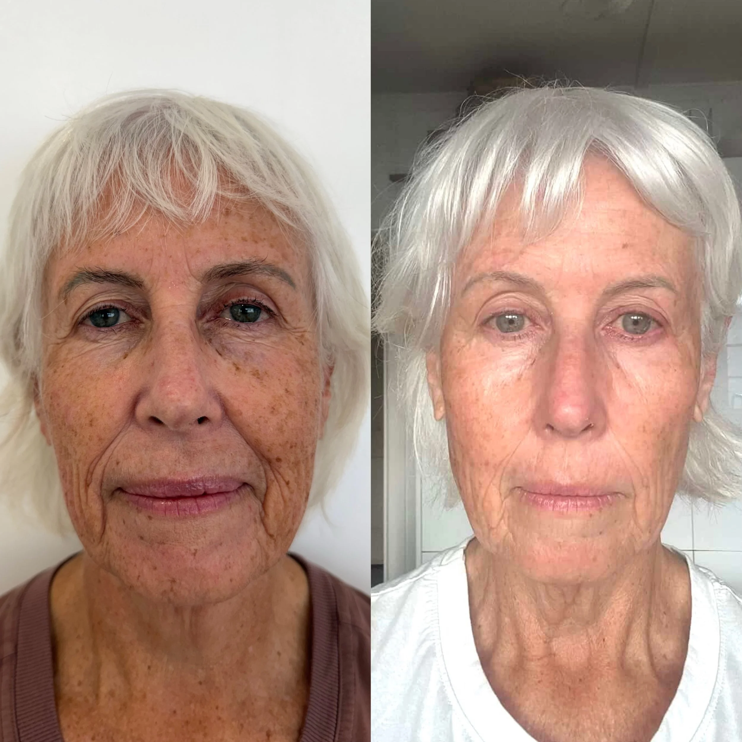 ✨ 1 month post High Energy NeoGen Plasma ✨

A beautiful example of what happens when we focus on rebuilding skin quality, not changing the face.

At only 4 weeks we can already see a softer, brighter complexion, improvement in years of sun damage, sm