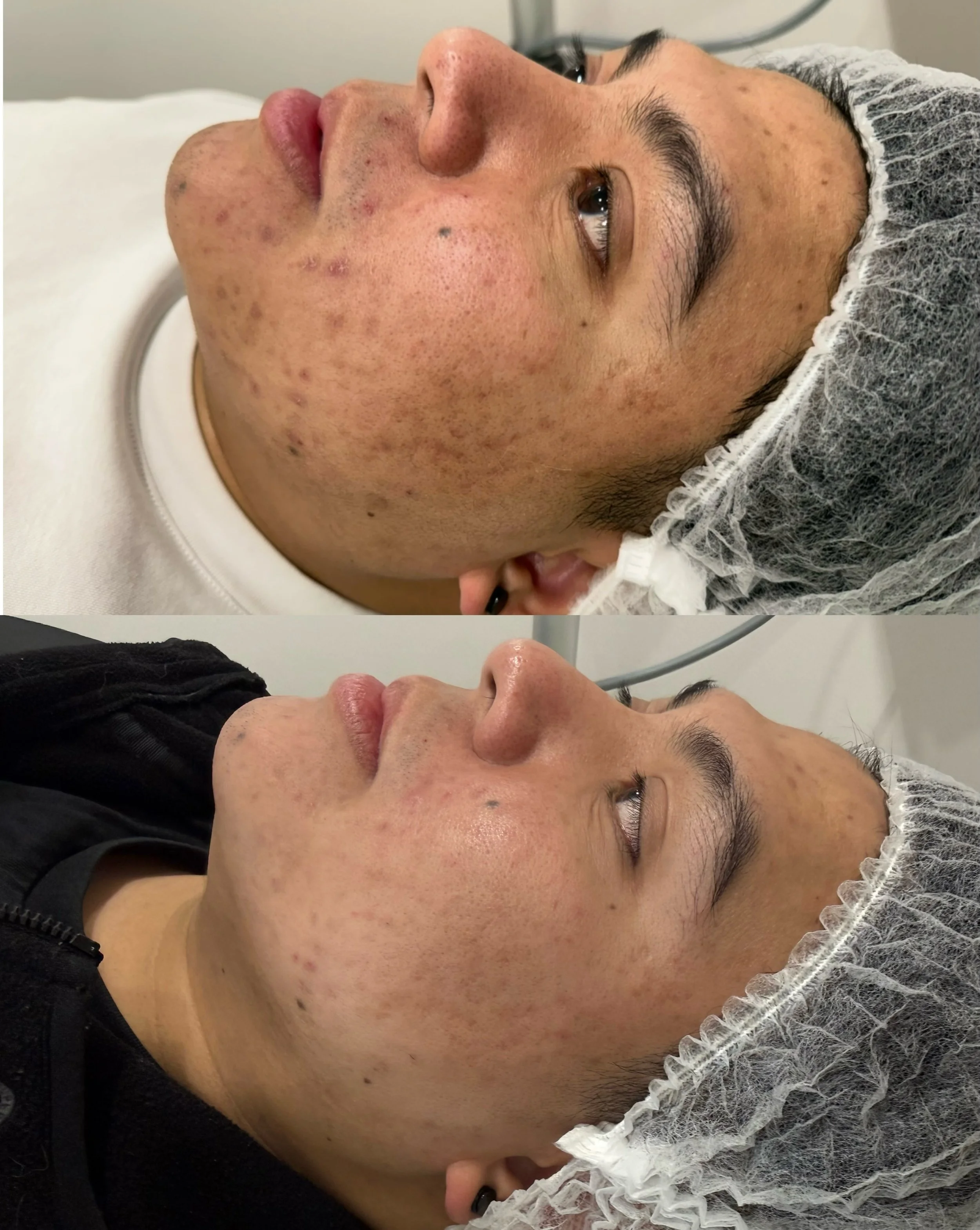 One BBL HERO treatment ✨
Less redness, softer pigmentation and a brighter, more even complexion. Huge Progress 🙌 #acneskin #bblhero #brisbane #brisbaneskin
