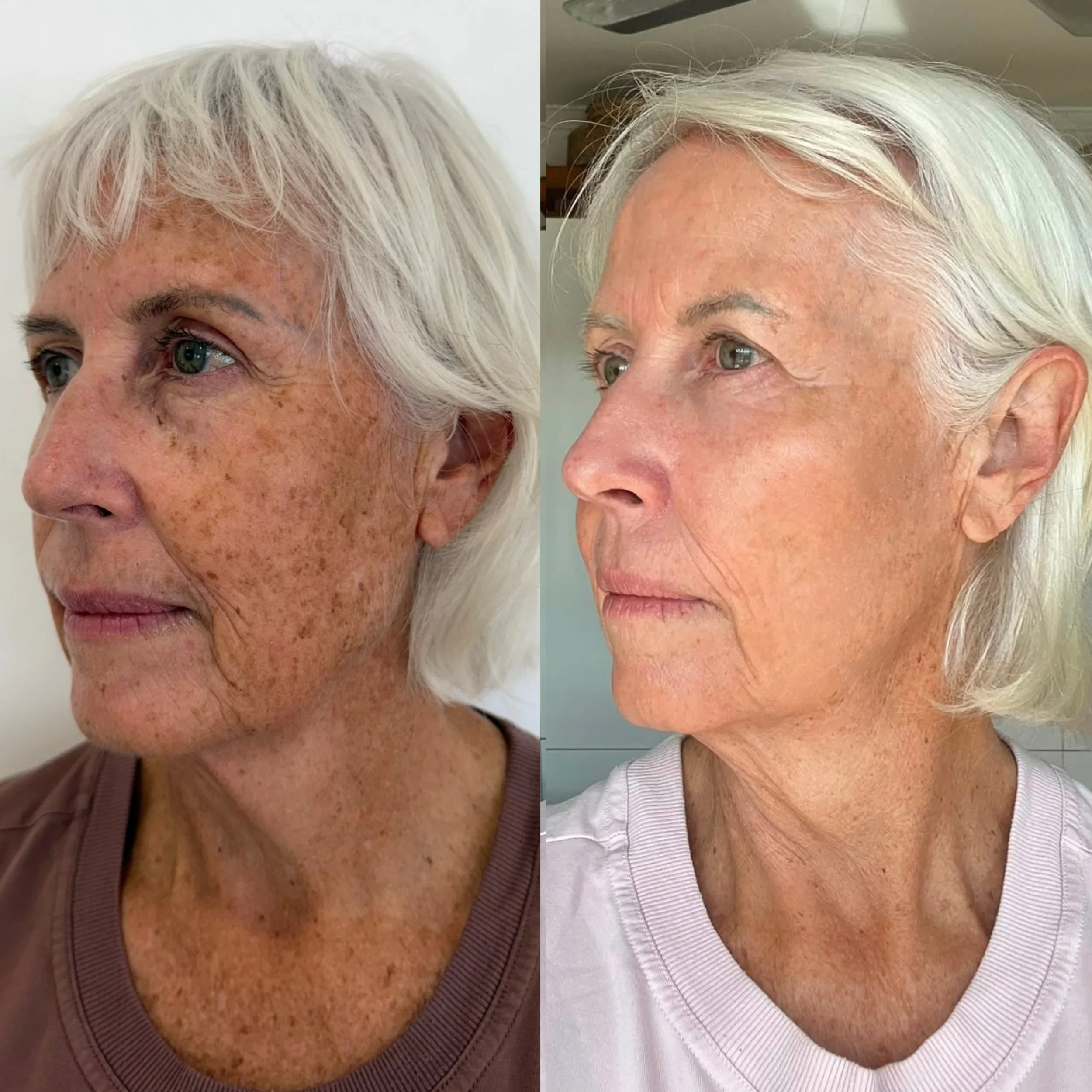✨ Meg&rsquo;s incredible skin transformation ✨

WOW&hellip; this is why I love what I do 🤍

Meg started her skin rejuvenation journey with NeoGen Nitrogen Plasma 7 weeks ago, followed by BBL HERO + MOXI only 1 week ago&hellip; and look at her skin ?