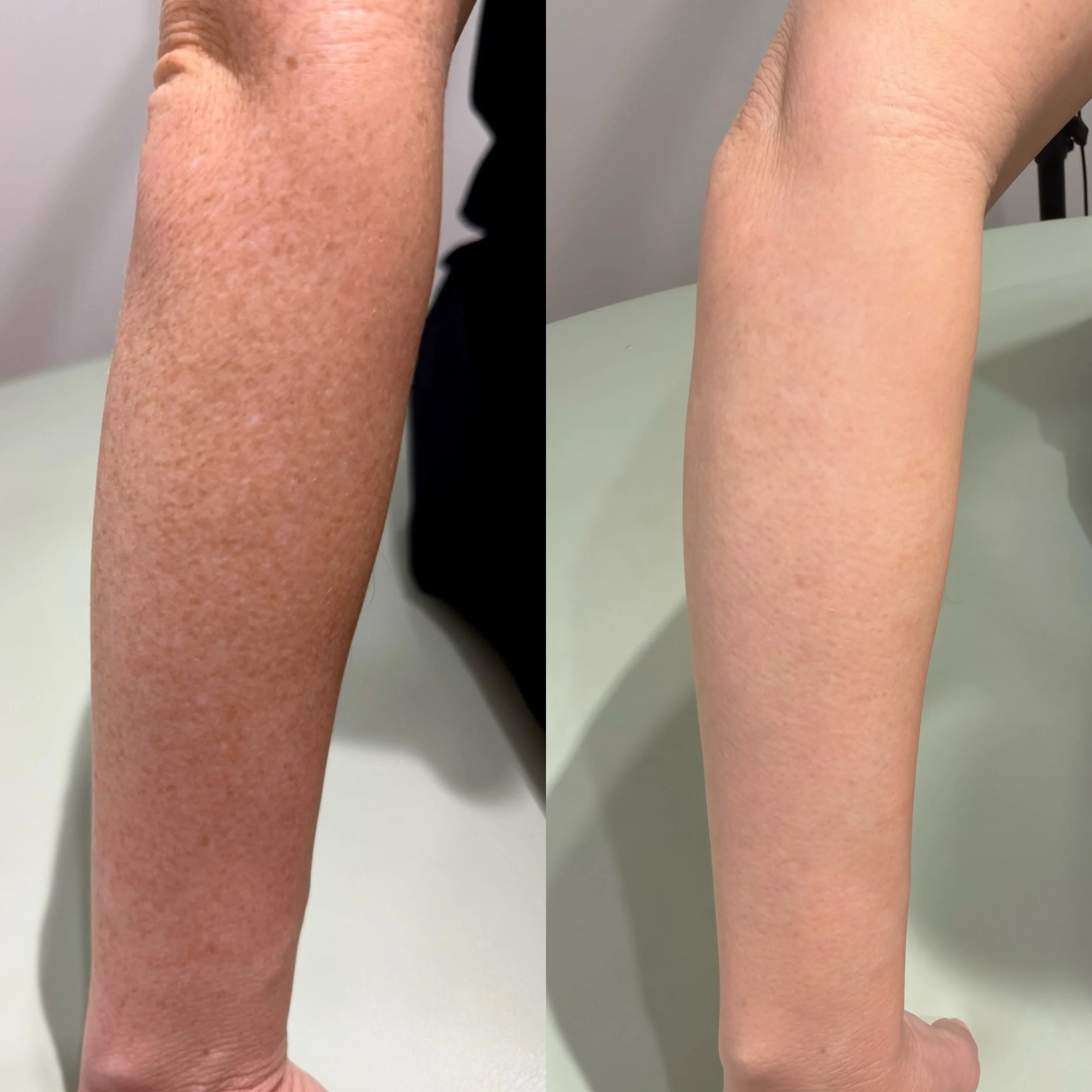 Results like these aren&rsquo;t luck. They&rsquo;re consistency. Swipe 👉

One treatment that I deliver time and time again with beautiful, predictable results.

Full both Arms only $277 🤯
Premium treatment without the premium price.

Book online vi