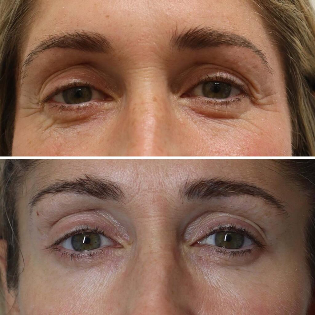 Close-up of a woman's eyes before and after cosmetic treatment showing reduction in wrinkles and skin tightening around the eyes.
