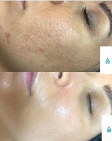 microneedling (1).jpg
