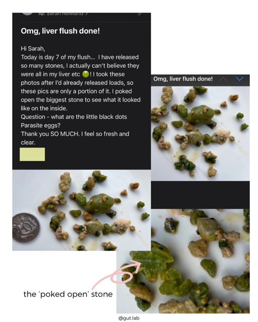 Image of liver stones and small parasite eggs, with a coin for size reference. Liver flushing for better health. Liver flush Nutritionist GUT LAB
