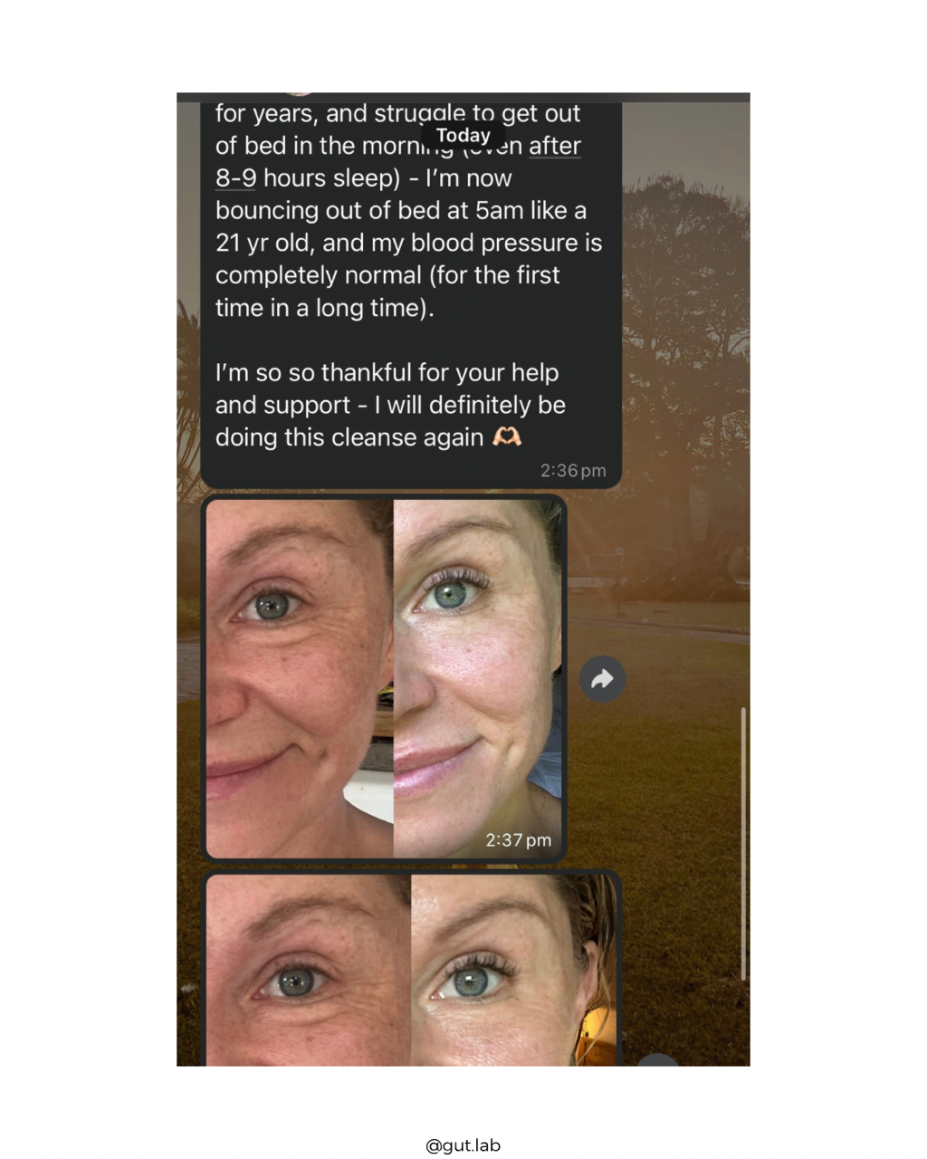 Liver flush results for skin and eye health. Liver flushing for general health, better vitality and detox.