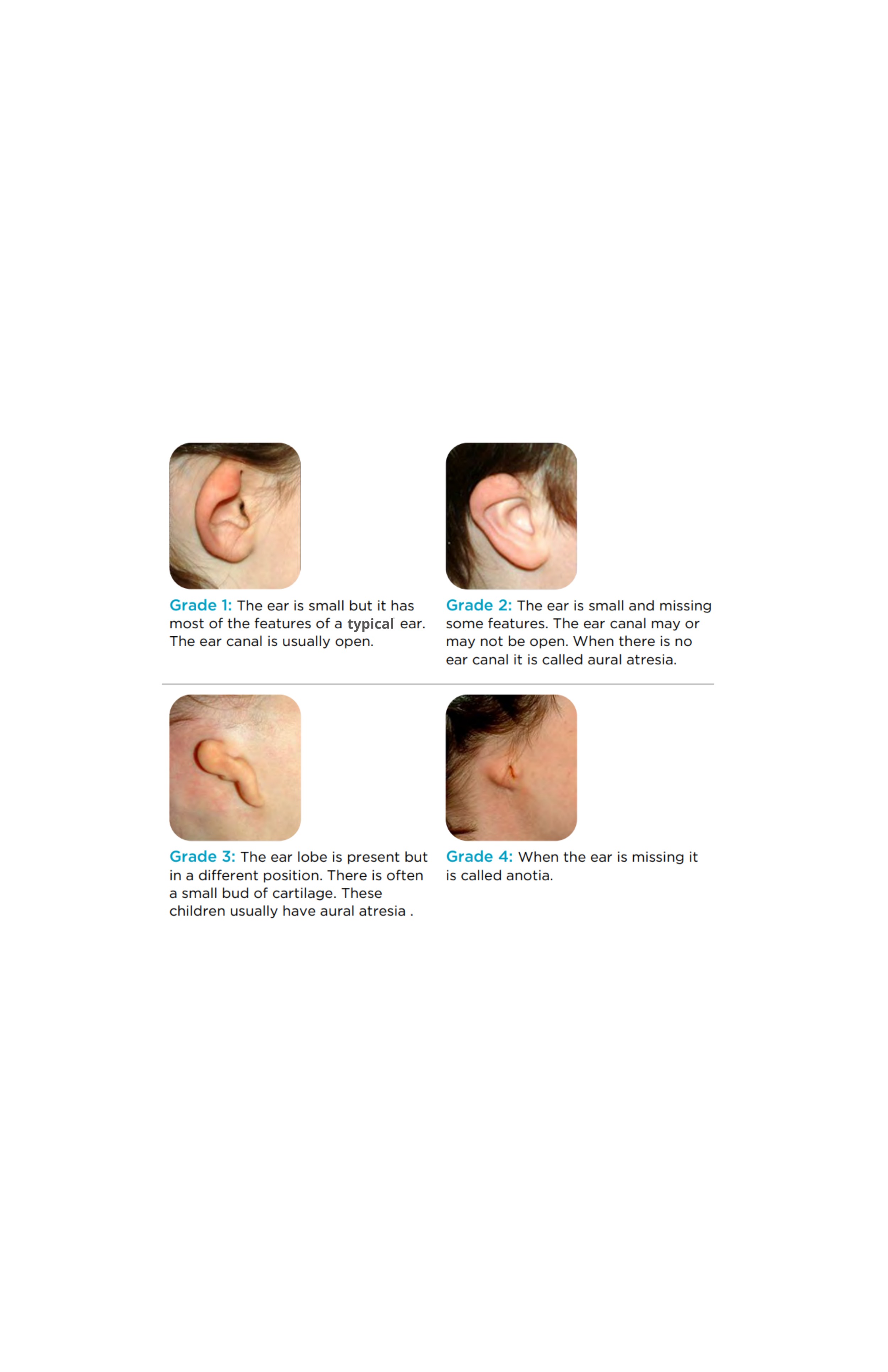 About Microtia — Craniofacialcare.org