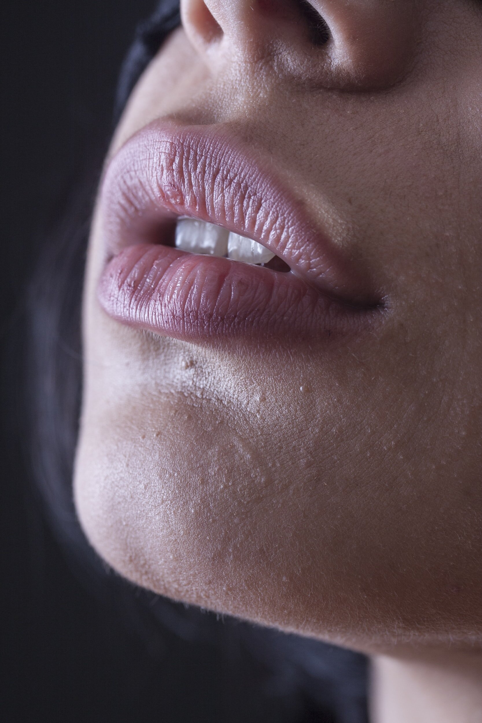 How do i prevent and heal cracked lips?