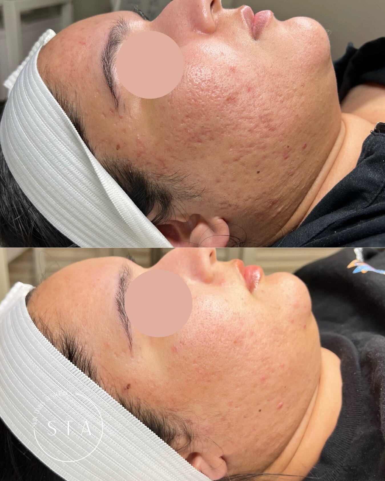 One of my Acne Bootcamp clients after only TWO SkinPen Microneedling sessions! The improvement after only two sessions has me so excited for what's to come.  Check out her very first before photo posted in September to see how far we've come. 🩷

Mic