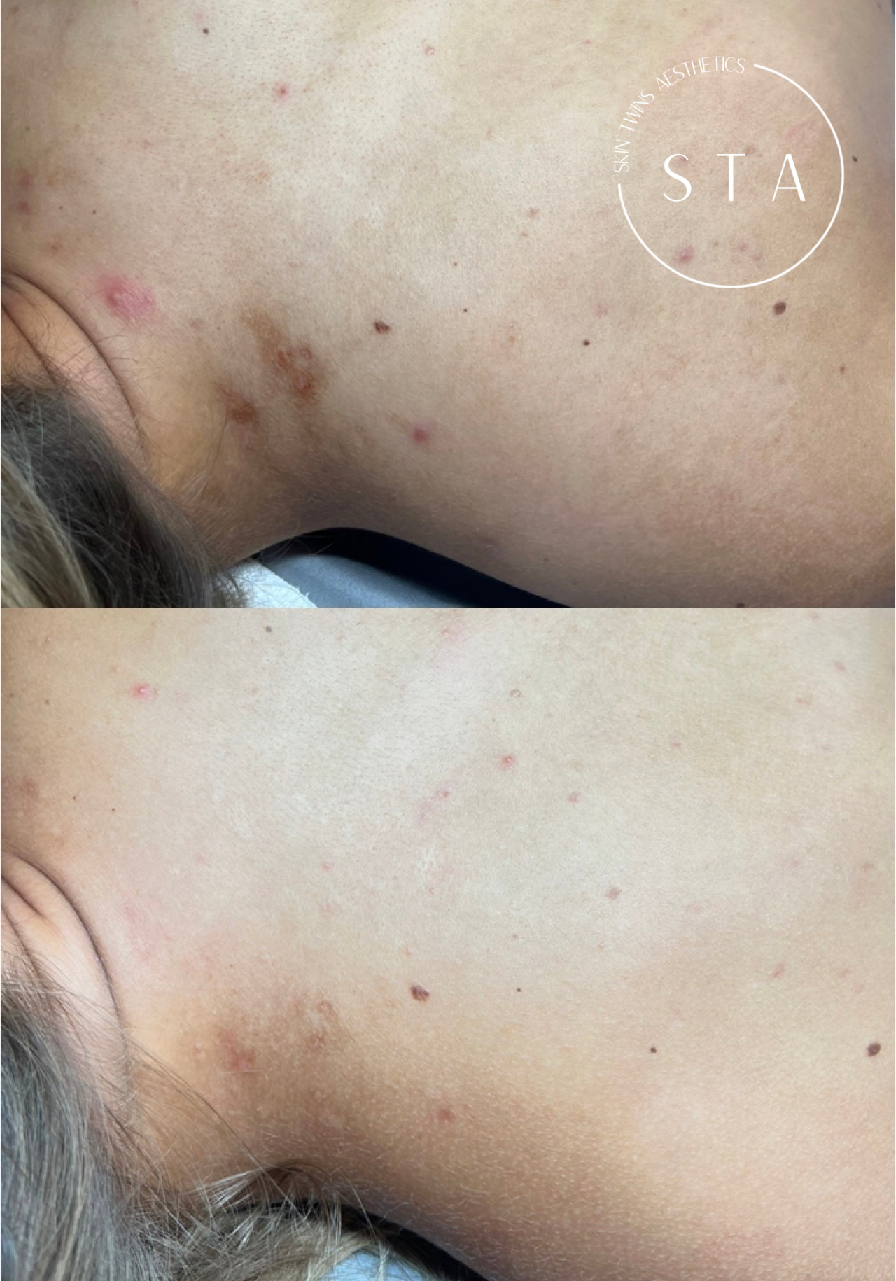 Perfect Derma Peel w/ Plus Booster