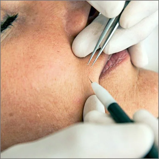 tri for electrolysis.photo.jpg