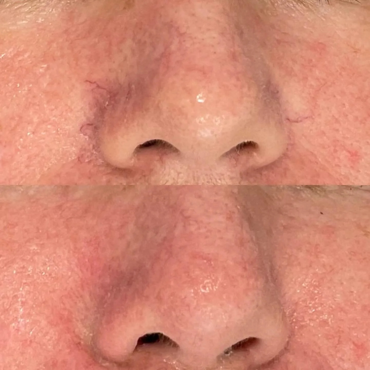 Before and After Excel V+ Laser treating facial veins. @cutera.anz.

These photo&rsquo;s were taken before and immediately after just one session! 

The Cutera Laser delivers pulses of light energy which causes the blood within the vein to coagulate,