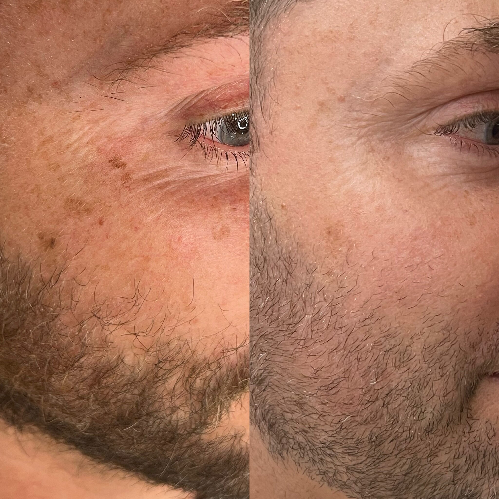 Pigmentation Reduction Results!

Using @cutera.anz Excel V+ Laser, pigmentation treatment is specifically designed to target sun spots, age spots, freckles and other pigmentation issues anywhere on the body&rsquo;s skin. 

If you want to learn more, 