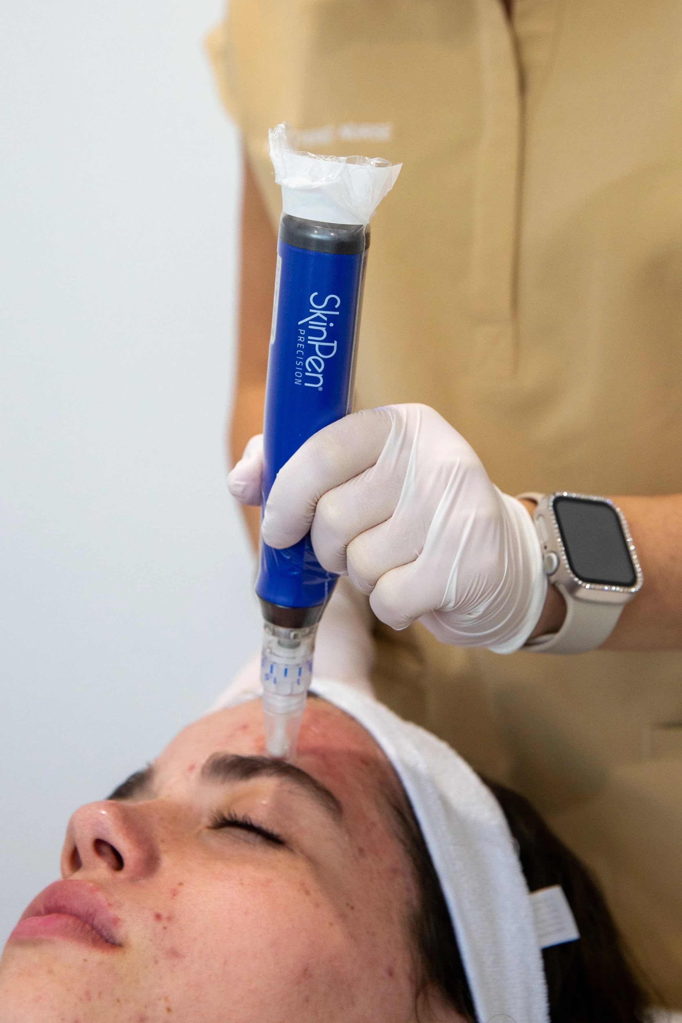 A person receiving a cosmetic facial treatment with a skin pen device, lying down with a white headband, while a technician wearing gloves and a smartwatch administers the procedure.