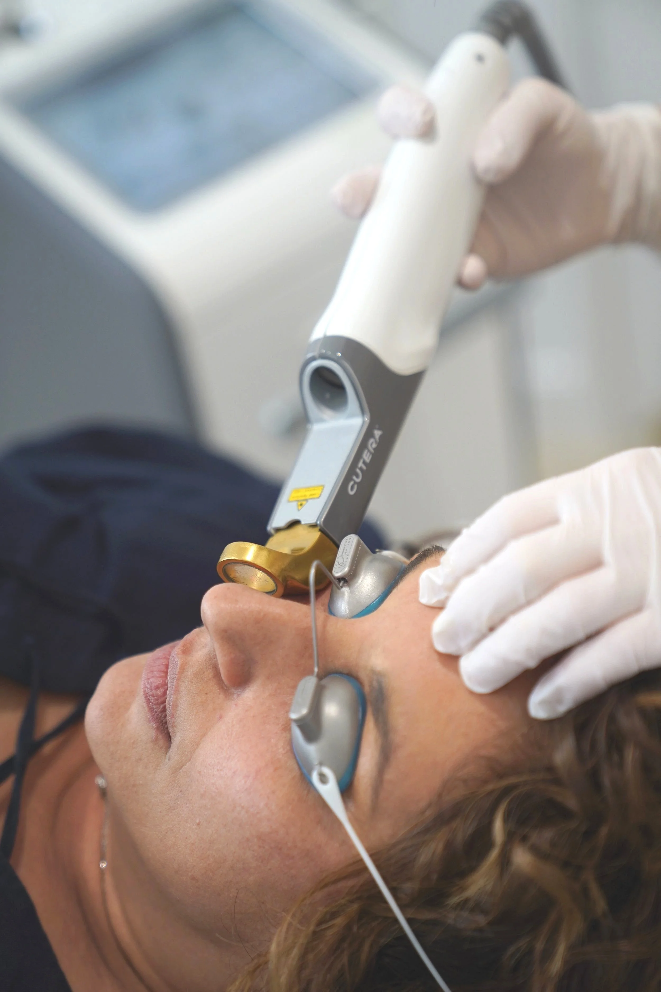 cutera laser for pigmentation and red vein removal brisbane