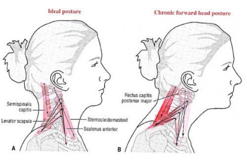 Common neck muscles that get tight with a forward head posture