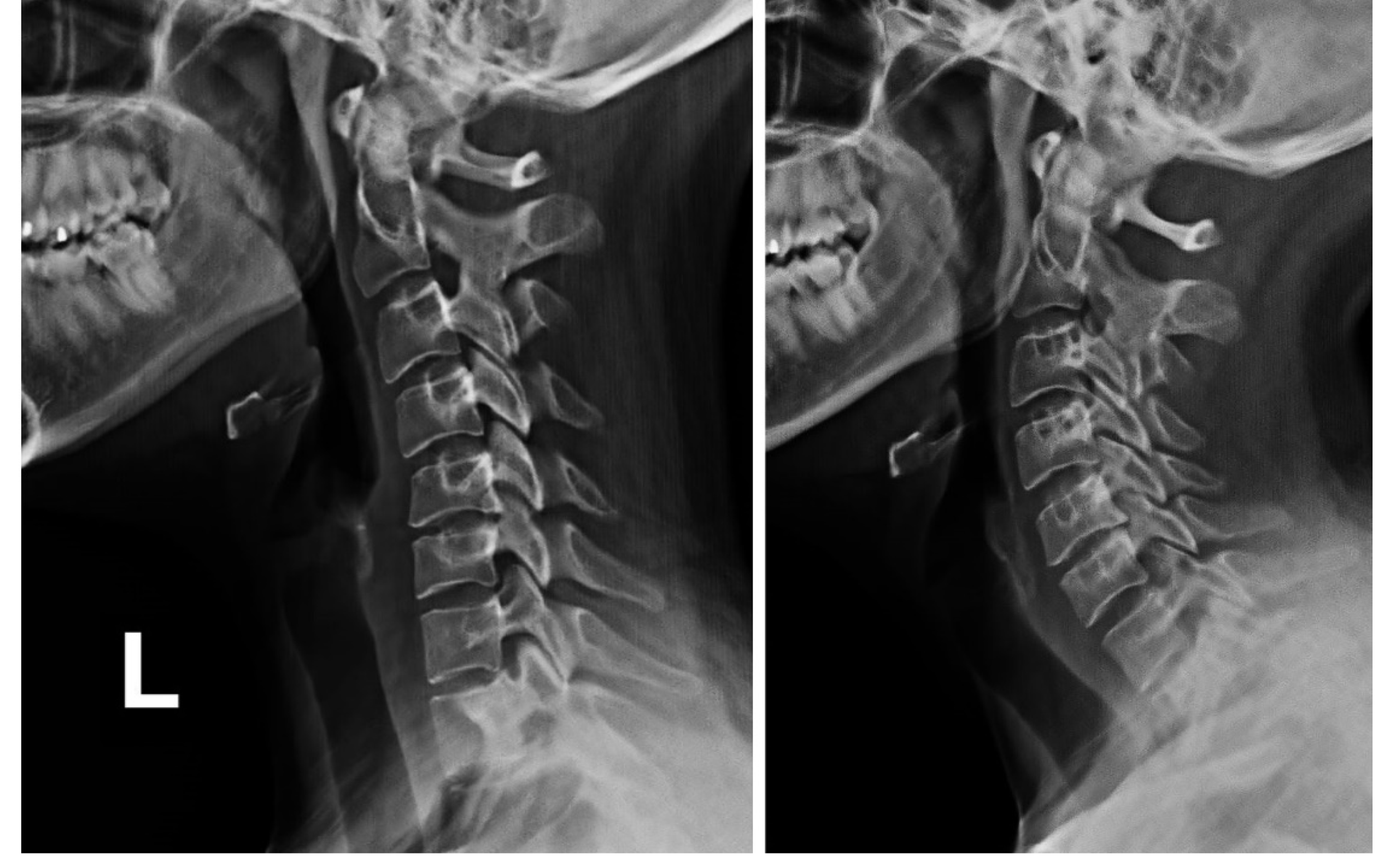Cervical spine on one side shows equal spaces between vertebrae while a forward head posture has a decrease in these spaces.
