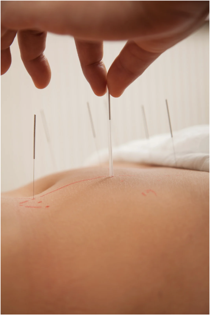 Why Choose Facial Acupuncture for Natural Facial Rejuvenation