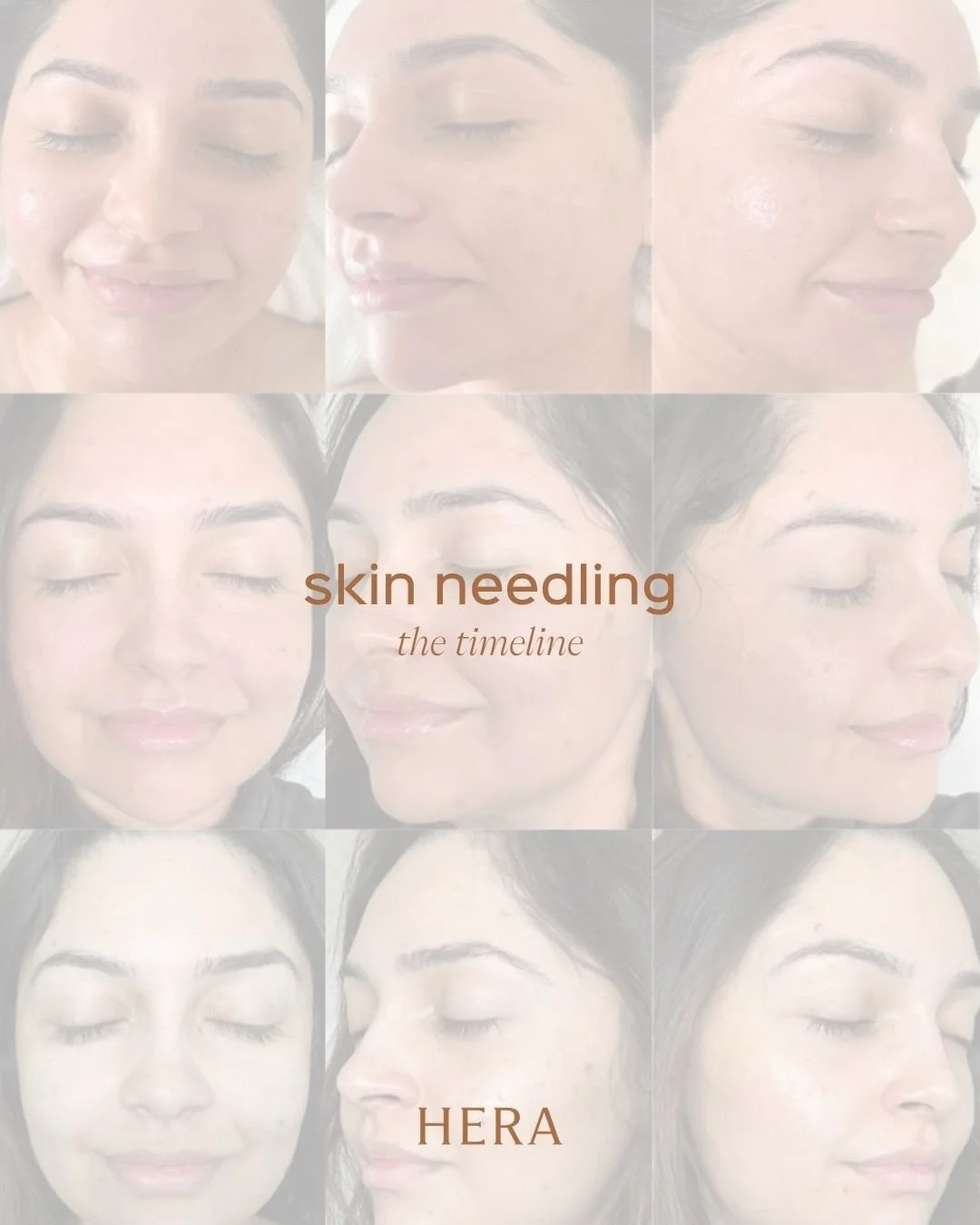 Skin needling is a process, not an instant result.
What you&rsquo;re seeing here is skin repairing, rebuilding, and strengthening over time.

Thinking about starting skin needling? Now is the ideal time to begin your treatment course!
Start now, and 