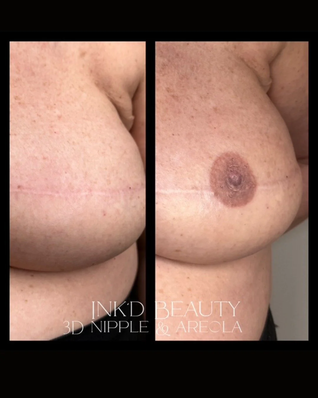 This beautiful restorative tattoo was completed by our tattoo partner, @inkdbeauty_byheidi!

💗 100% funded by your donations 💗

We're continuing to change lives and create hope - one tattoo at a time.
.
.
.
.
#restorativetattoo #breastcancersruvivo