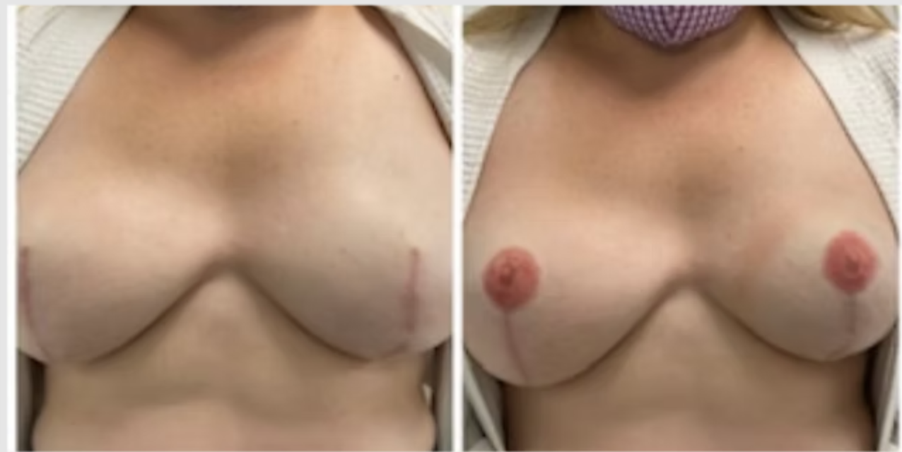 Vee - Areolas.png