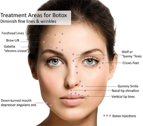 Botox Winks Botox & Wrinkle Relaxers in Tuckahoe, NY | DR. G Prevention & Wellness