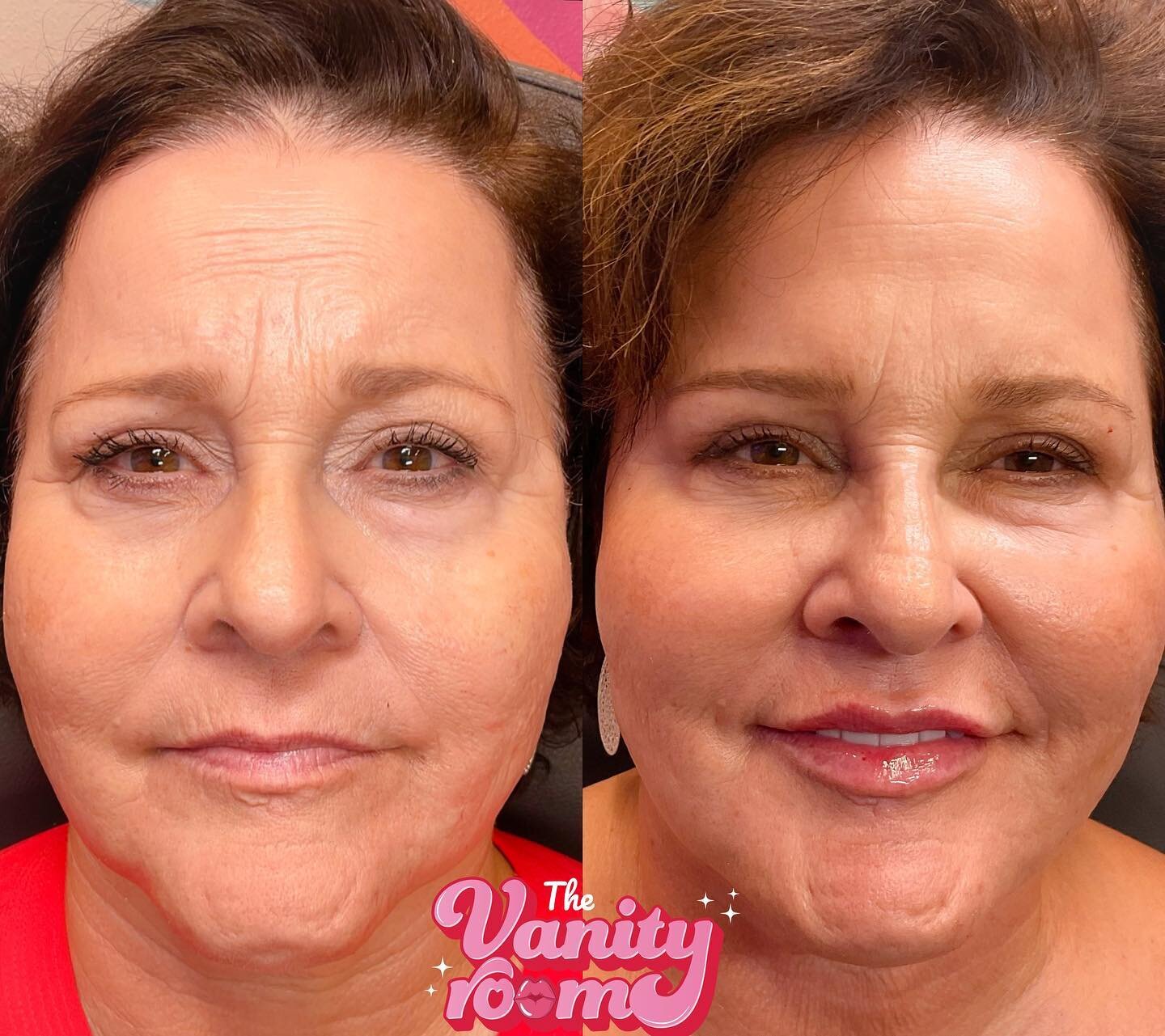 Wowwww! She looks sooo REFRESHED!  2 week follow up.  This was a 2 part process! This transformation &hearts;️. 1. PDO threads 2. Botox 3. Filler to cheeks, marrionettes, chin, frontal jawline, smile lines 4. Lips and lip lines.  #orlando #ucf #orlan