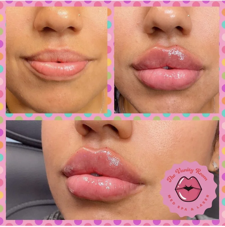 Lip Fillers in Orlando, FL — The Vanity Room Orlando