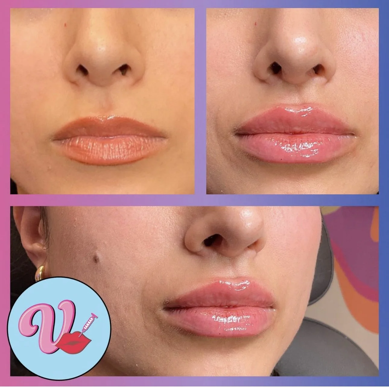 Lip Fillers in Orlando, FL — The Vanity Room Orlando