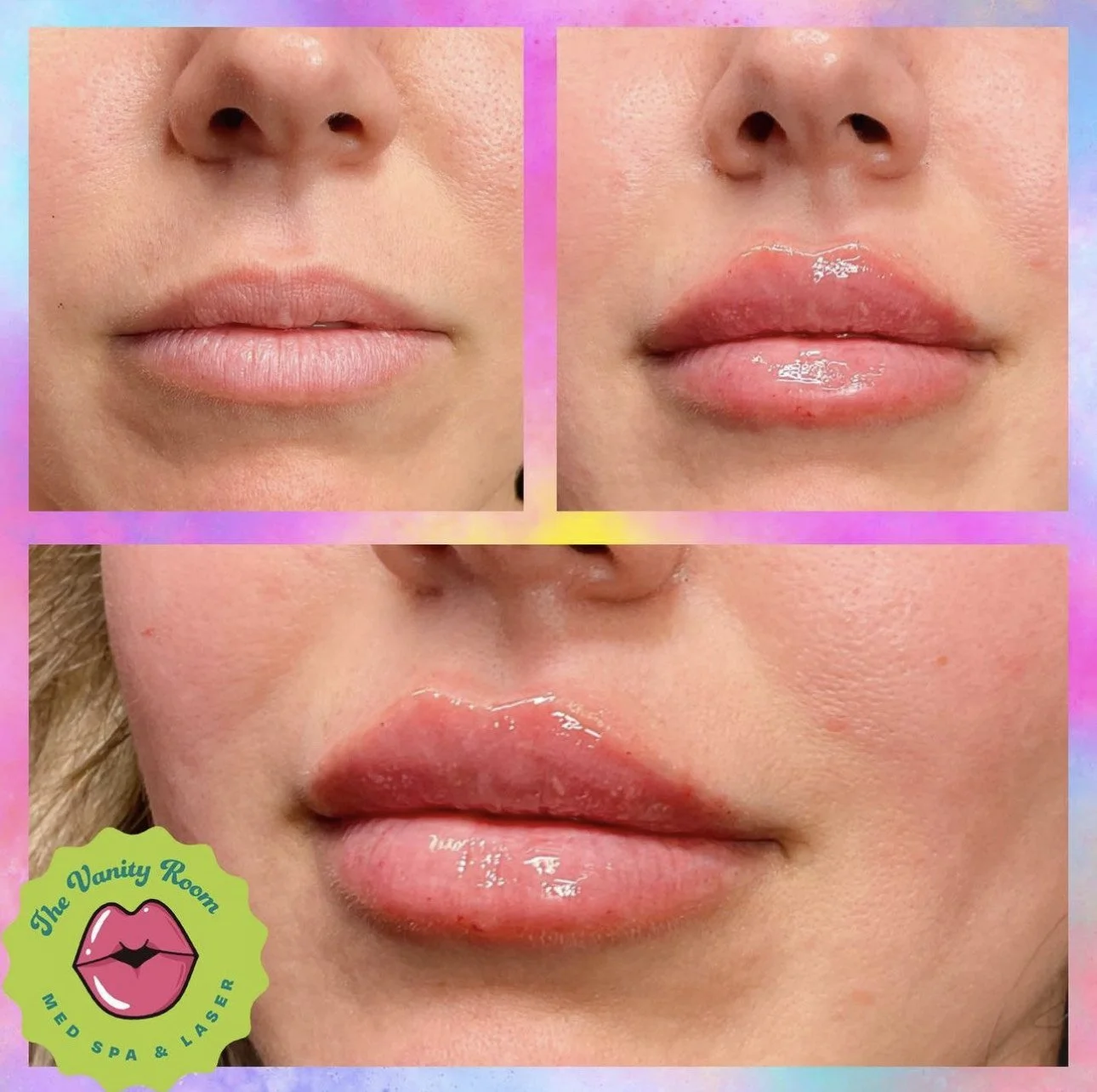 Lip Fillers in Orlando, FL — The Vanity Room Orlando