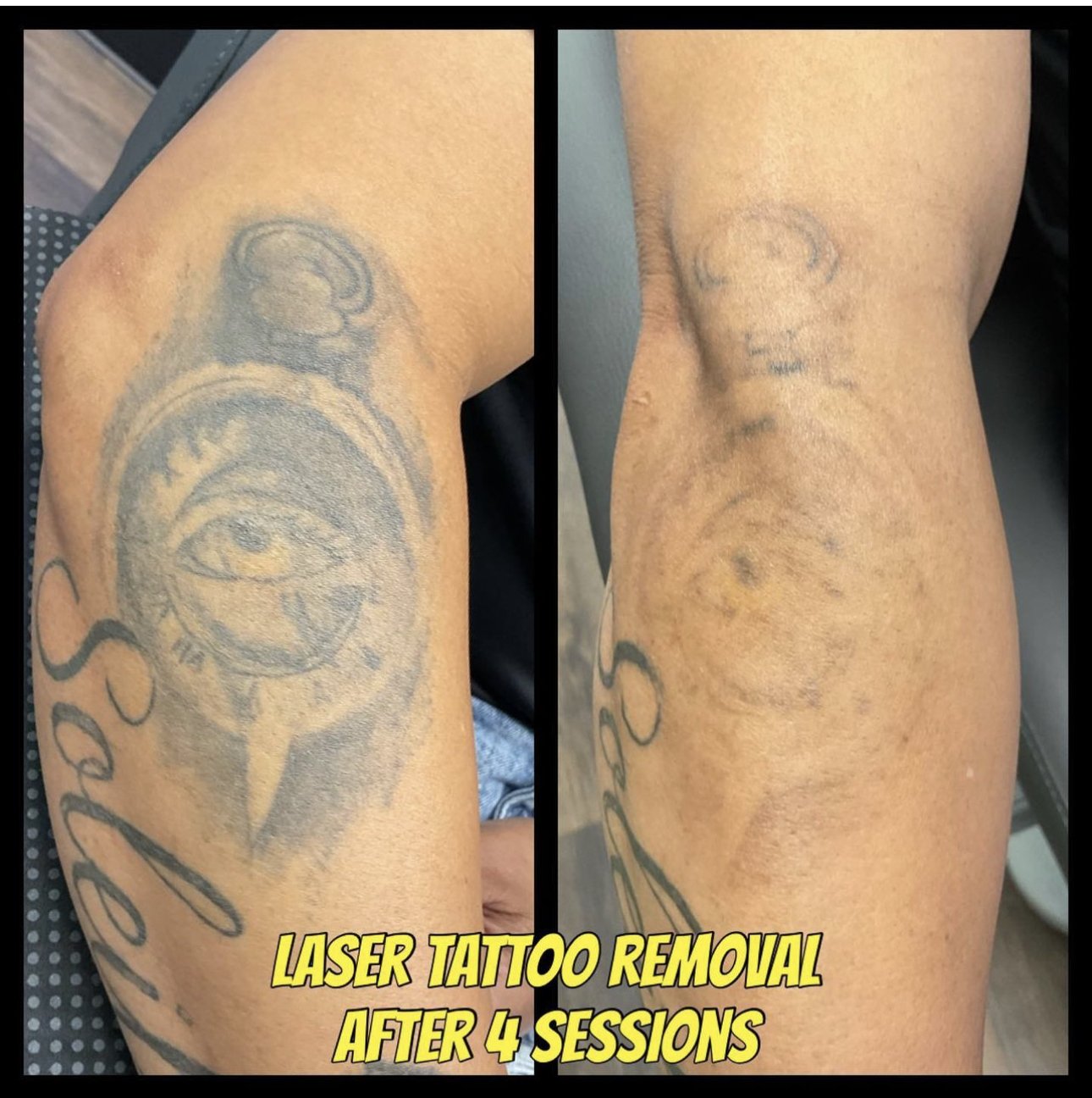 Laser Tattoo Removal (Per Square Inch); 10 Sessions – dr LASER