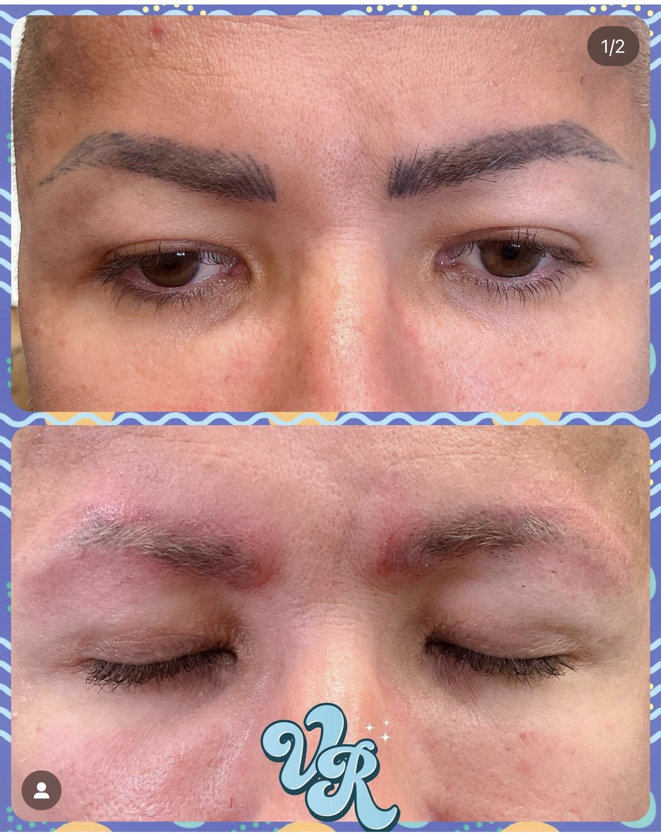 Laser Tattoo Removal in Orlando, FL — The Vanity Room Orlando