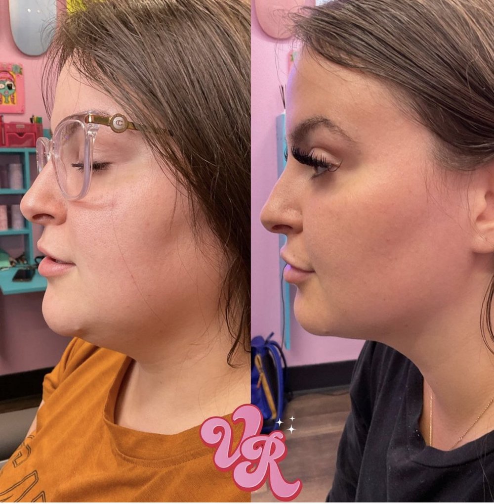 Kybella Liquid Lipo in Orlando, FL — The Vanity Room Orlando