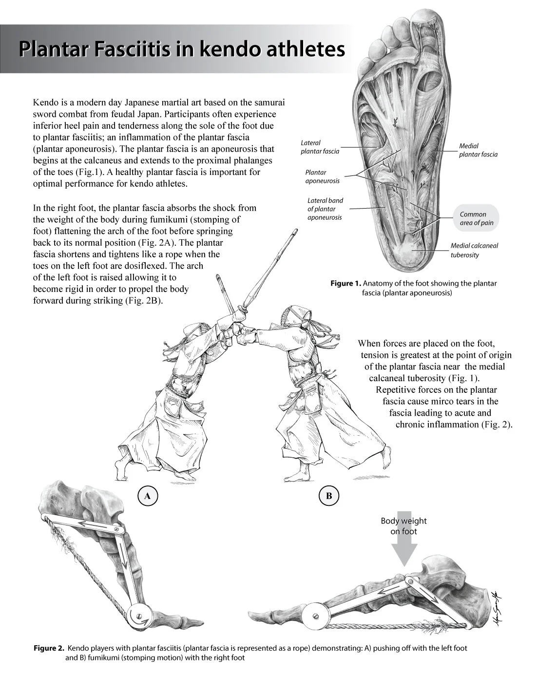 Plantar Fasciitis in kendo athletes