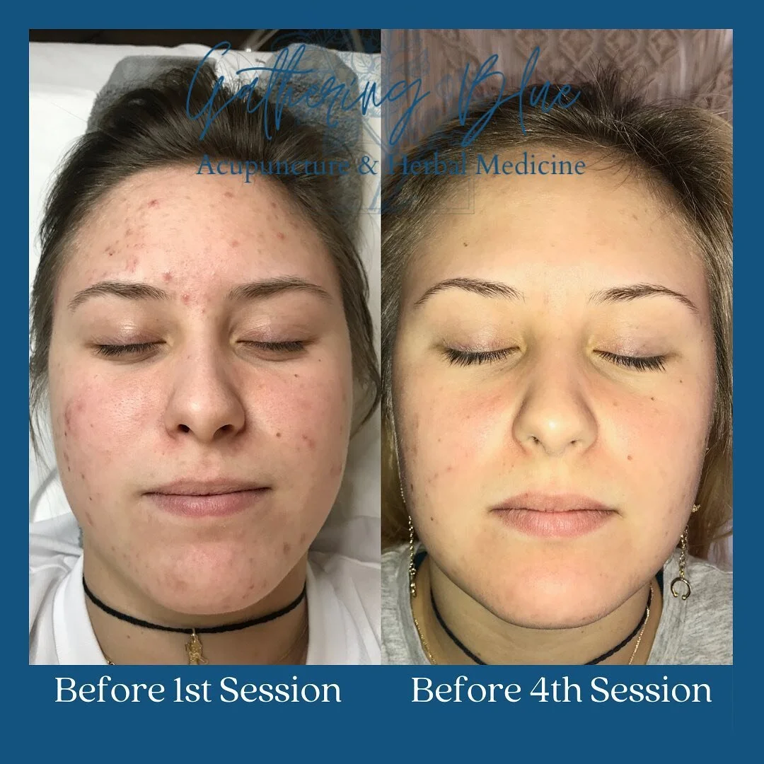 Y&rsquo;all, I&rsquo;m going to cry 😭 
This absolute BEAUTY is Krystyna and she just had her fourth Holistic Microneedling session with me.

Before we started she was telling me how she was frustrated with her skin and scarring and she was about to 