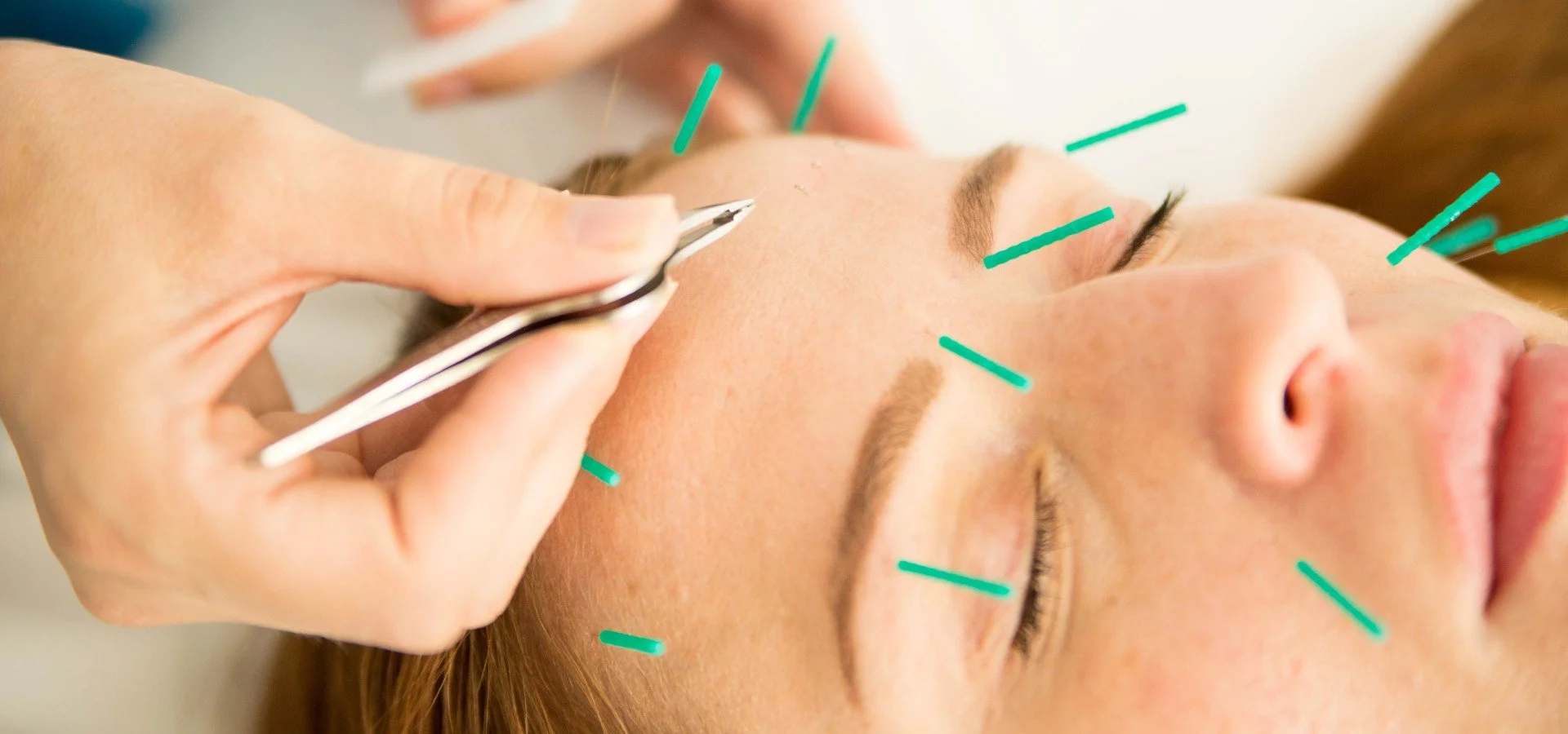 A woman receiving acupuncture with thin needles inserted in her face.