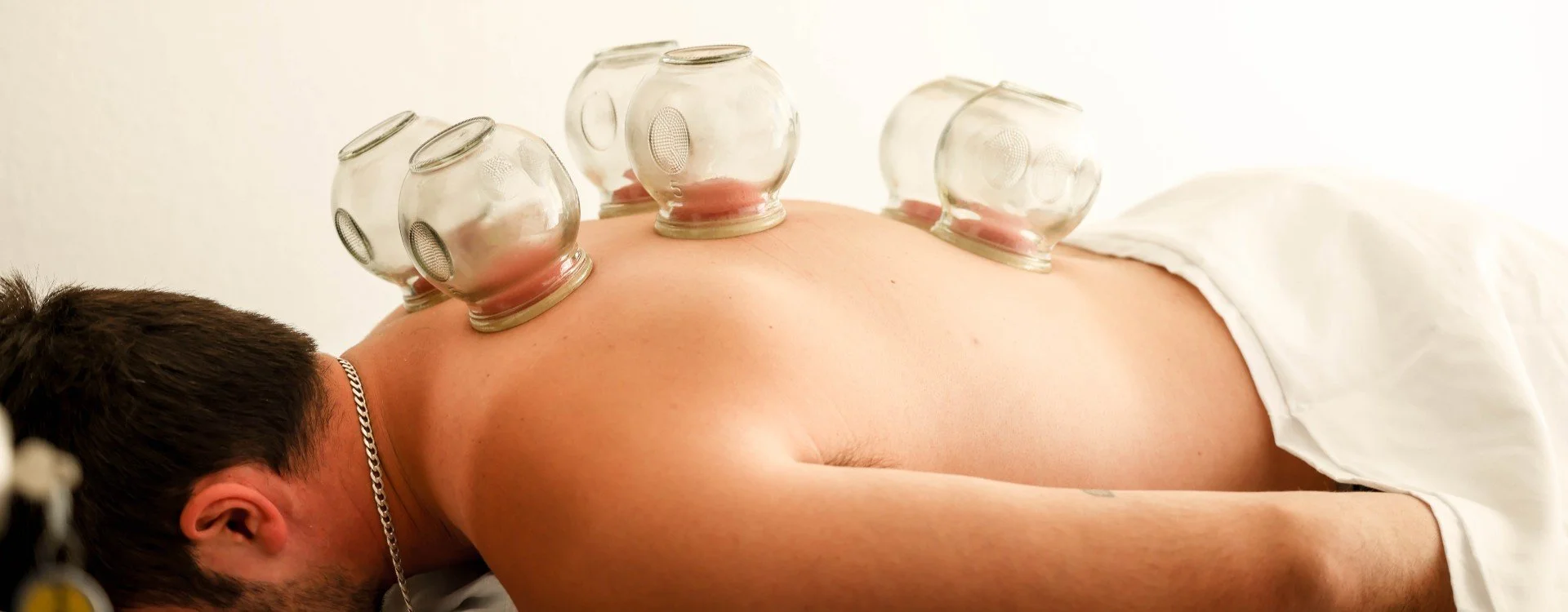 Person receiving cupping therapy on their back in a clinical setting.