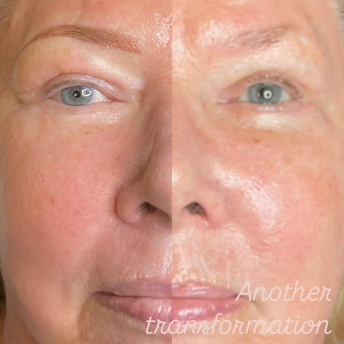 🤩 From barely there to sculpted&hellip;. the results are amazing! Want to upgrade your brow game?

Treatment- Powder brow touch up
Duration: 3 hrs
Pain level (1-10 scale) - 3
Healing period: 2 weeks
Retention: 1 - 1.5 years before touch up
~~~~~~~~~