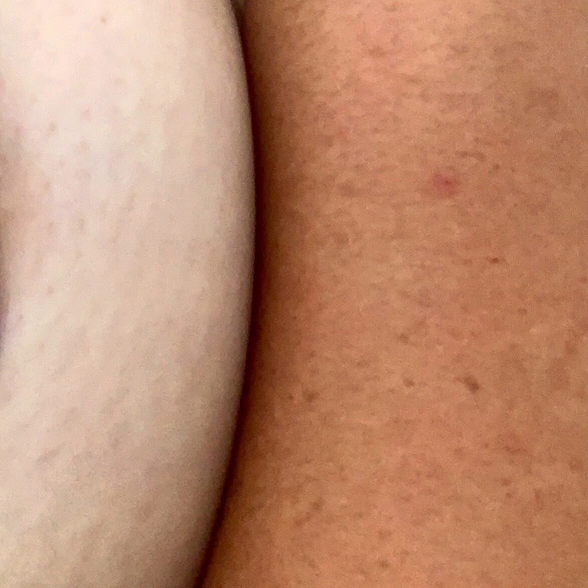 Every summer, the Levantine genes and the Nordic genes have a showdown 😂 Yes, these are both on my body. My parents aggressively different ethnicities like to fight it out on my skin. This is why foundation is stressful !!!