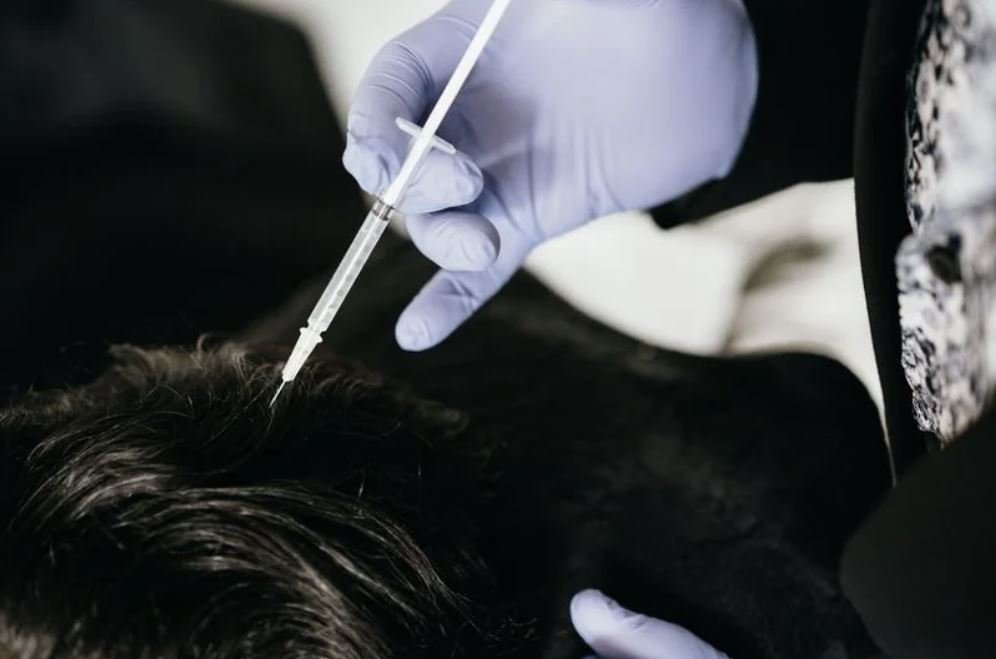 PRP vs GFC: A Comparison of Hair Loss Treatments in NZ