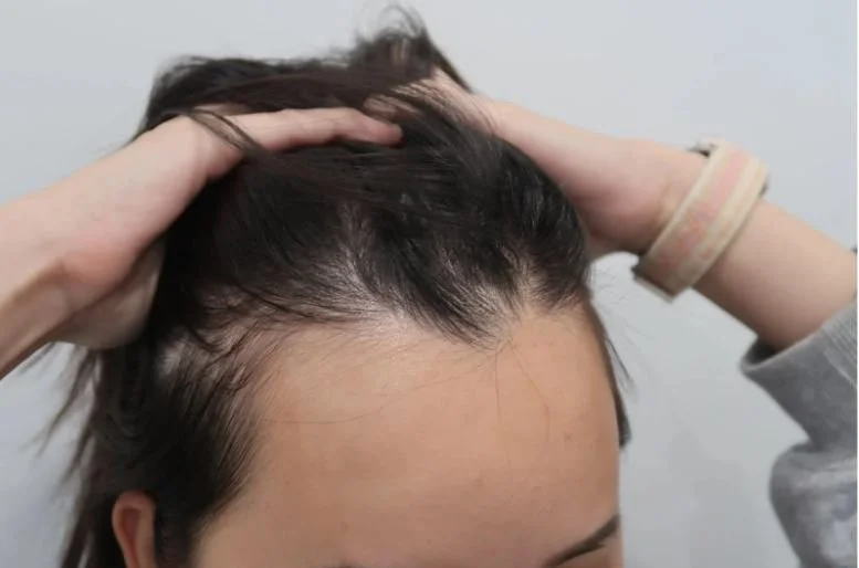 The Psychological Impact of Post-Menopausal Hair Loss and How to Cope