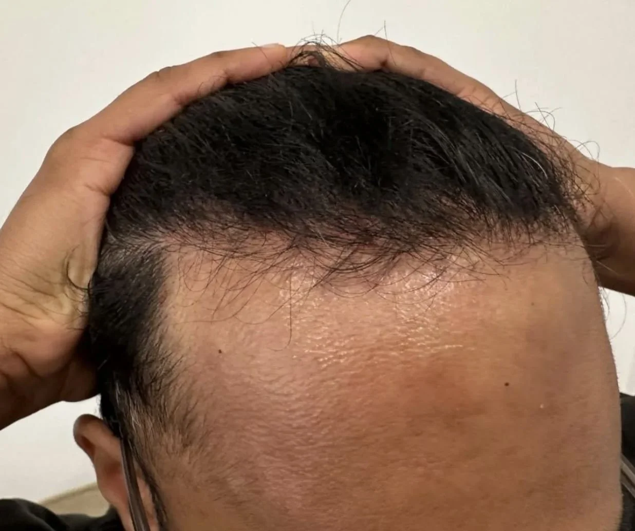 Scalp Inflammation and Hair Shedding: Signs Your Scalp Needs Treatment, Not Just Products